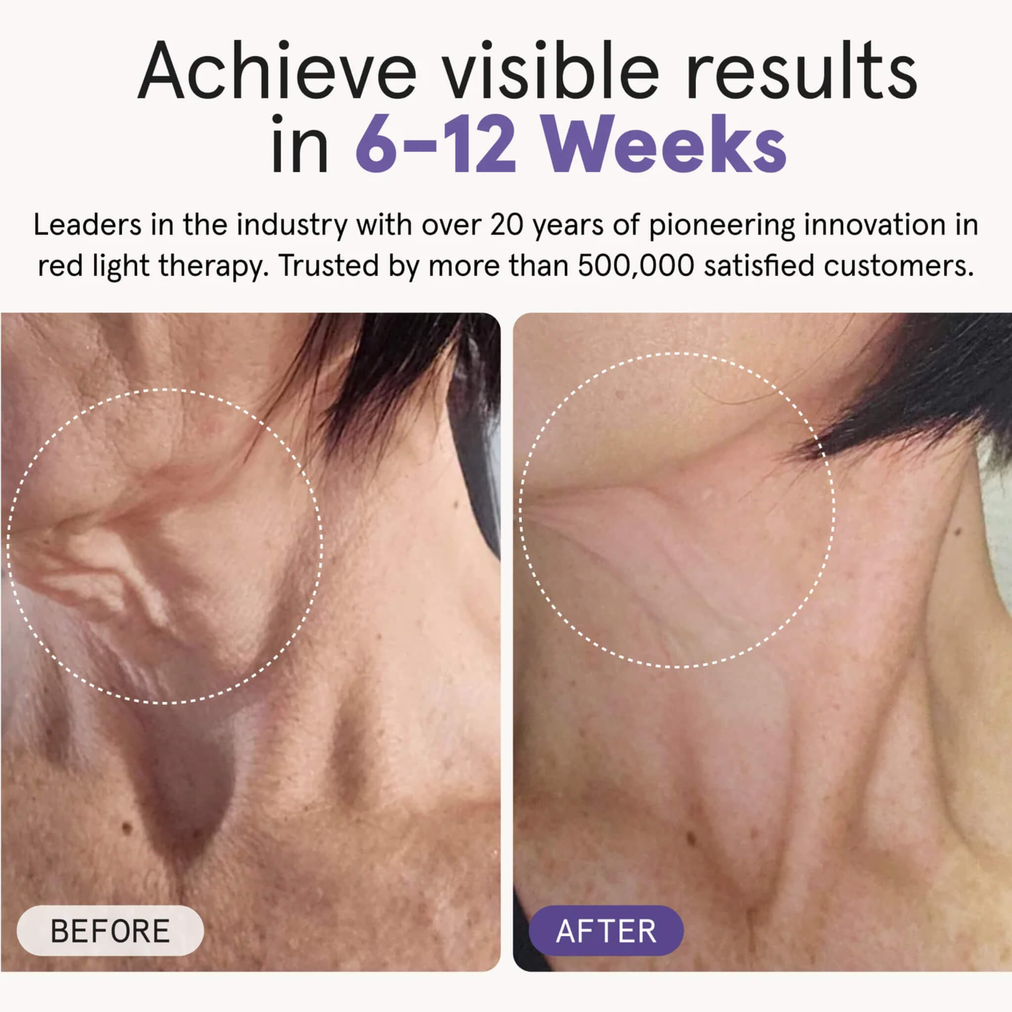 Before and after photos showing neck skin improvement after using the iRESTORE Illumina Neck & Chest Mask