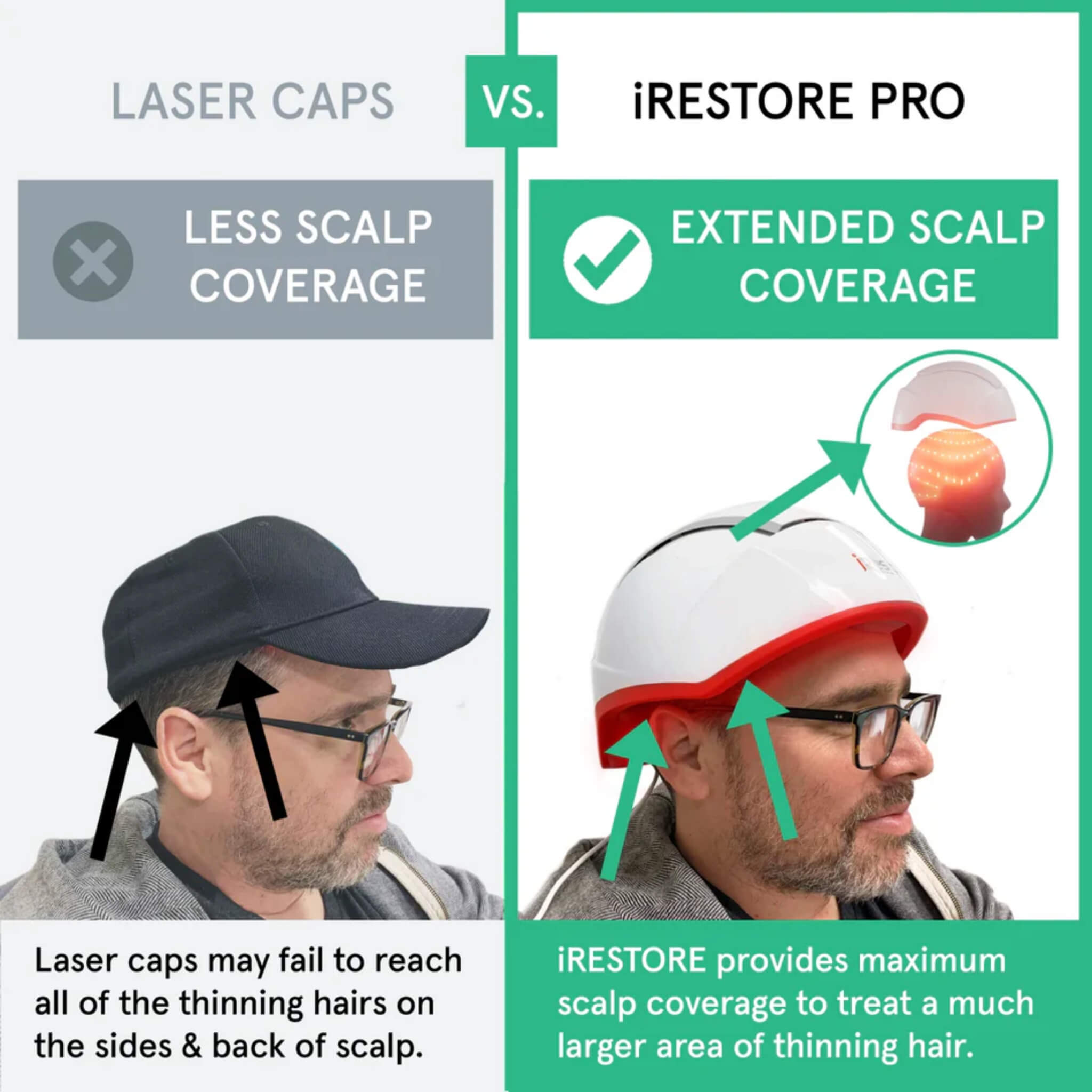 Comparison of iRESTORE Professional extended scalp coverage versus standard laser caps