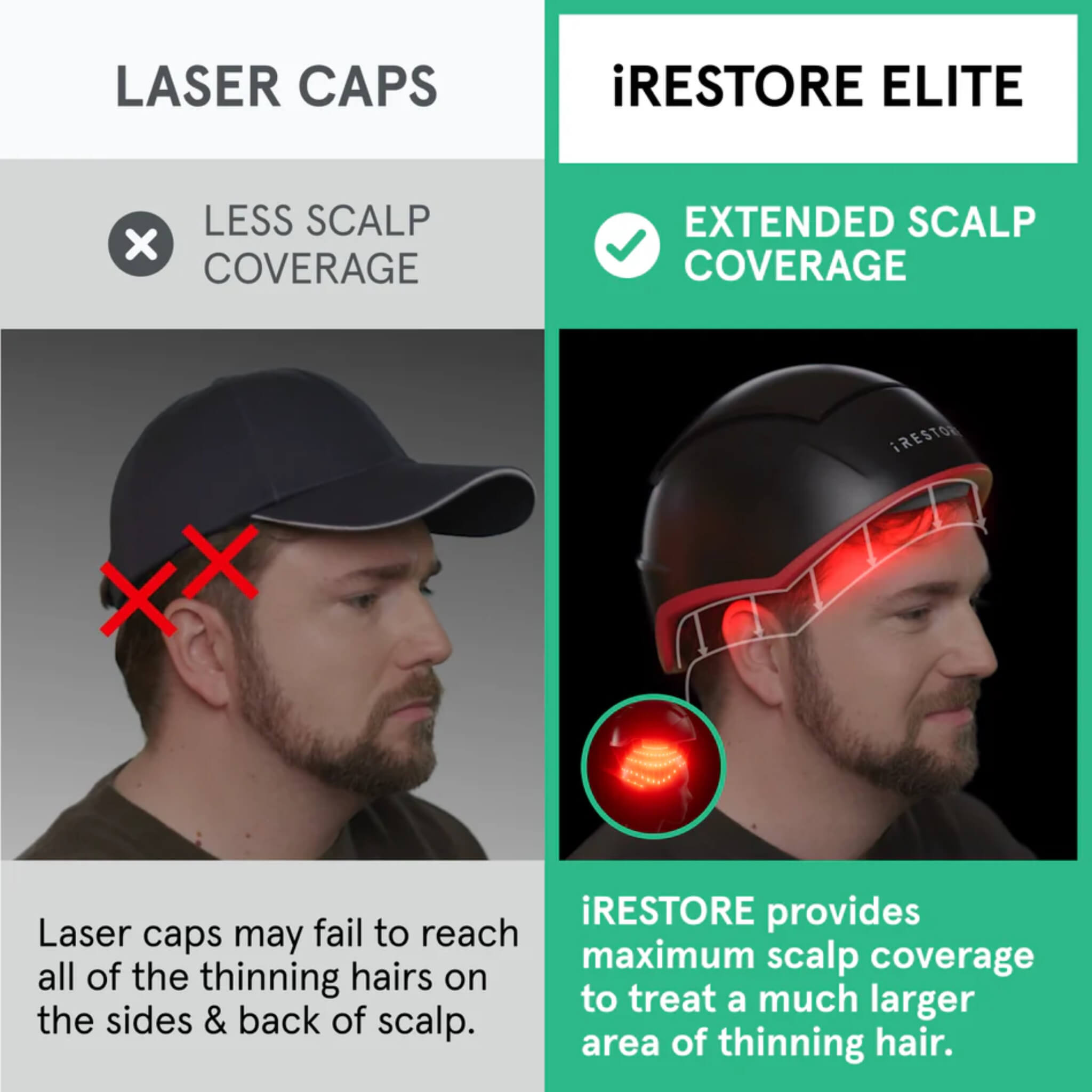 iRESTORE Elite extended scalp coverage comparison versus standard laser caps showing superior hairline and side coverage