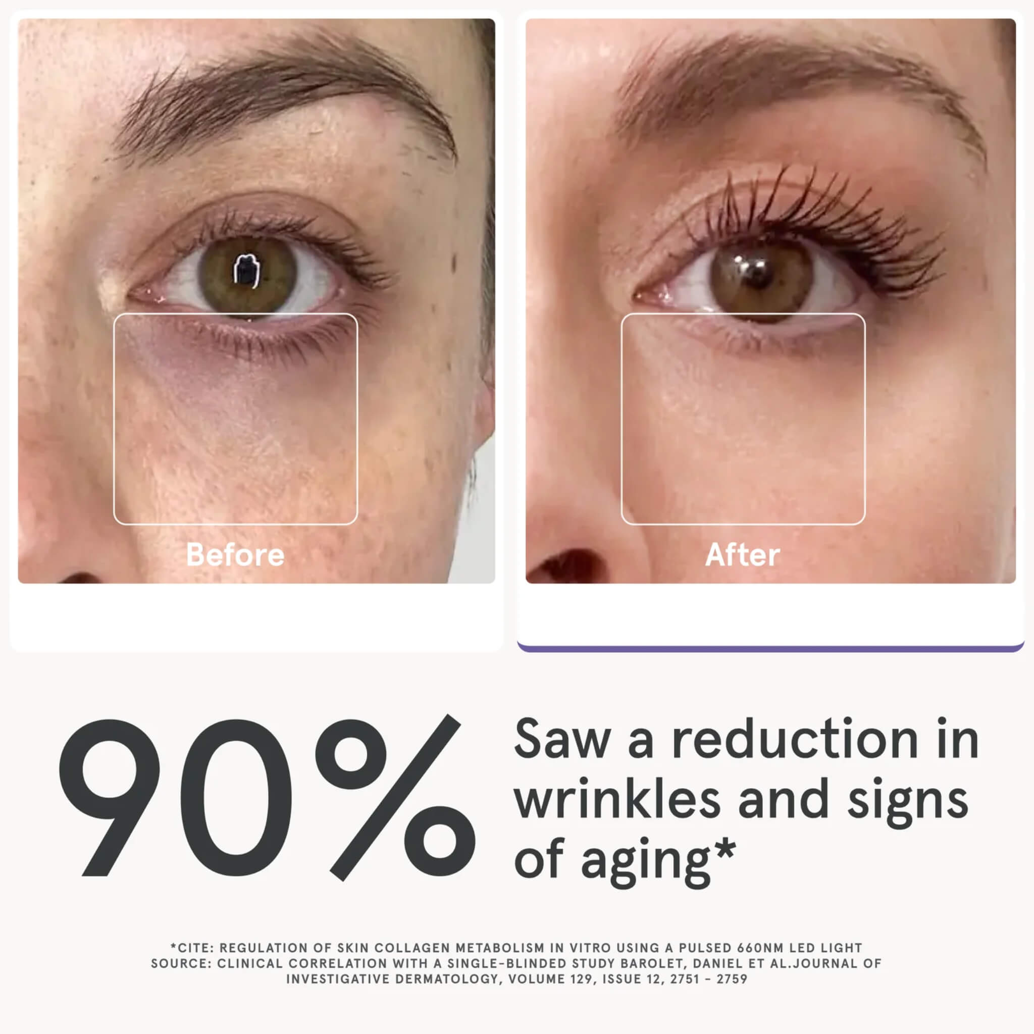 Before and after eye area photos showing 90 percent reduction in wrinkles and signs of aging